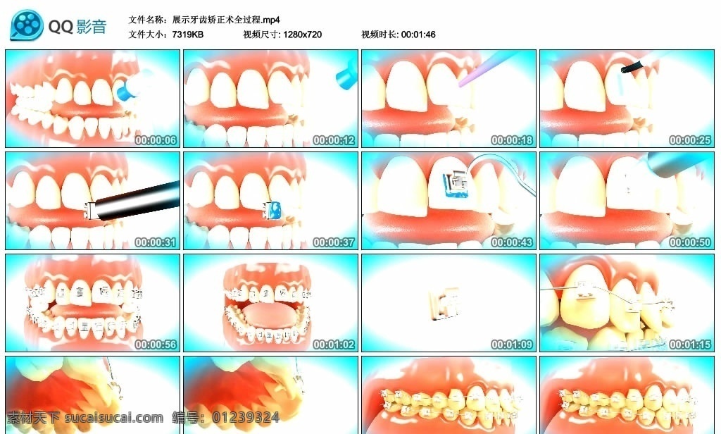 展示 牙齿矫正 术 全过程 牙齿矫正术 蛀牙表现 牙齿 矫正 铁丝 牙齿矫正扣 多媒体 实拍视频 mp4