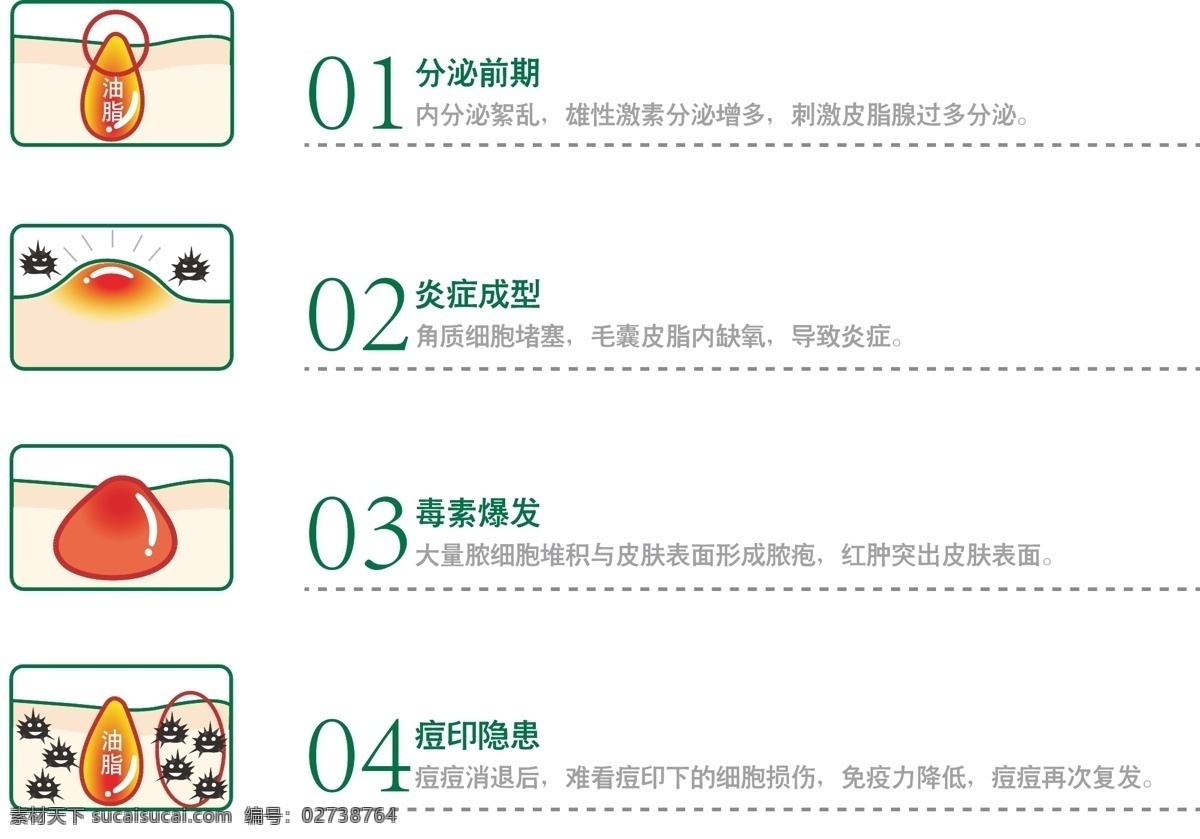 痘 形成 痘痘 生活百科 医疗保健 痘形成 过程 青春痘 矢量 海报 其他海报设计