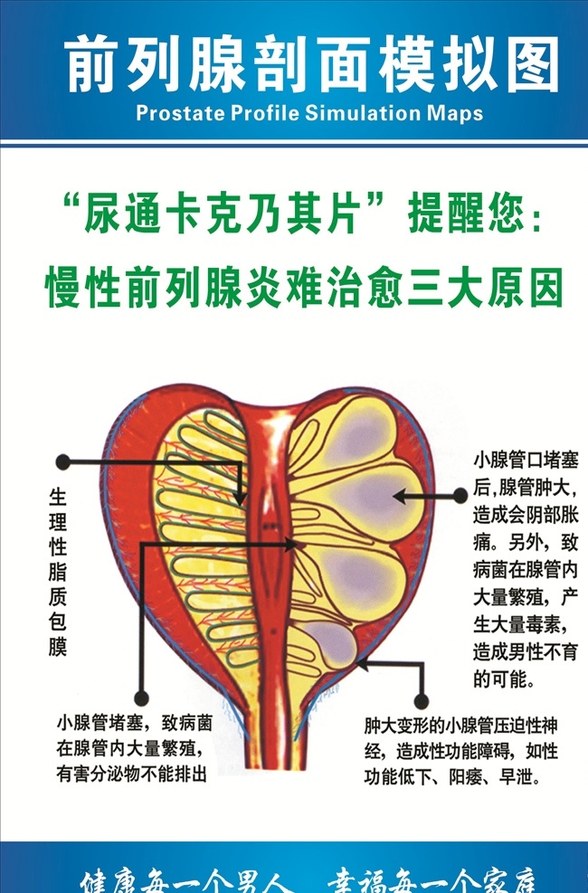 前列腺 剖面 模拟 图 剖面模拟图 慢性前列腺 前列腺炎 医院 健康男人 疾病 医院健康类