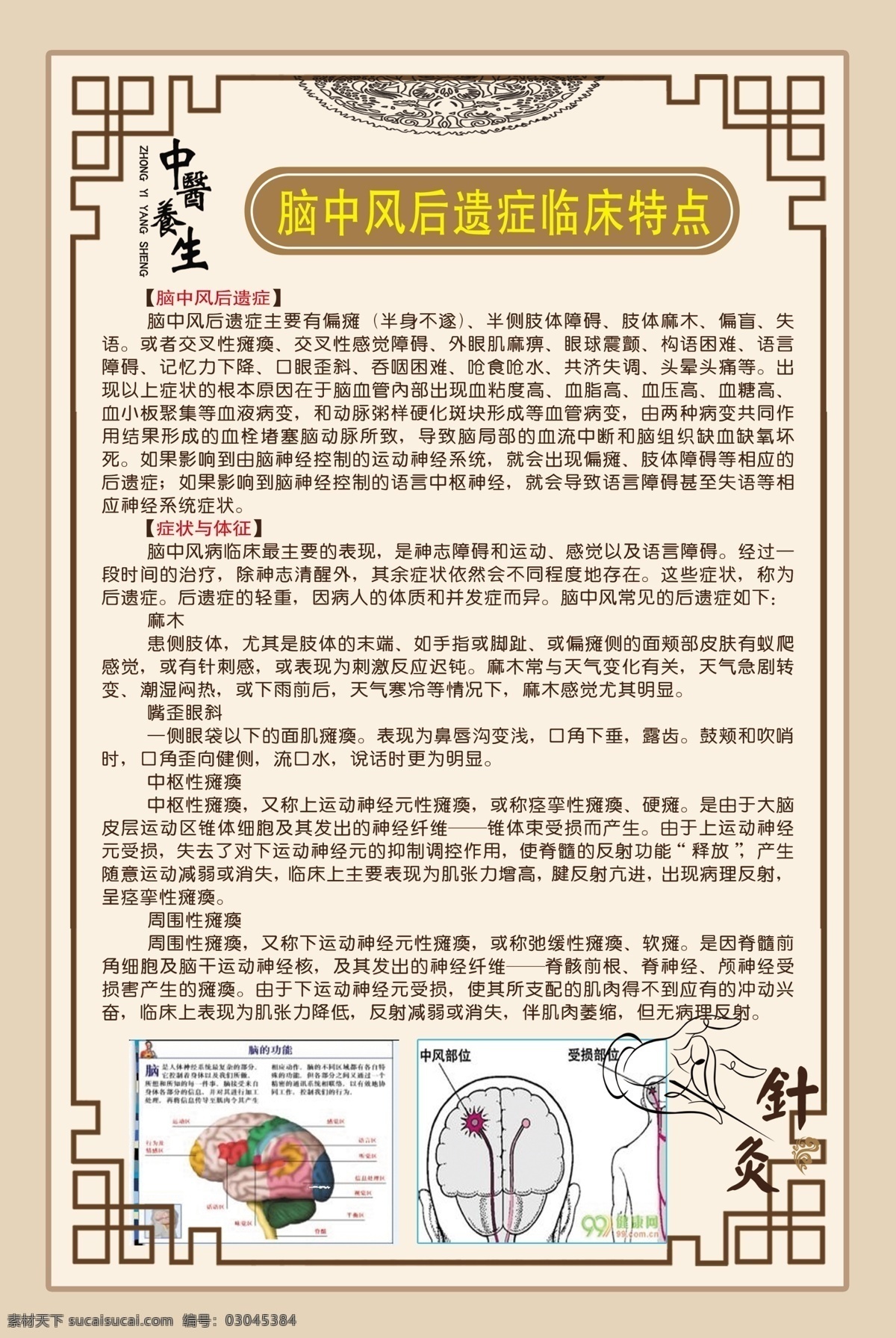 中医 医学 针灸 人体学 中风后遗症 分层