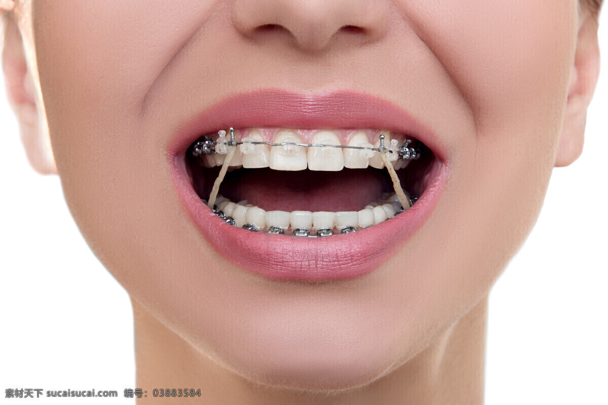 牙齿矫正 牙齿 牙箍 牙套 牙线 洁白牙齿 口腔护理 牙科 生活百科