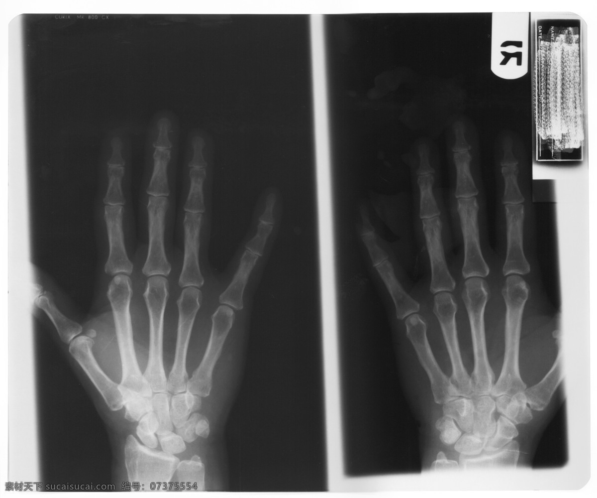 手部x光片 放射 无名指 现代科技 医疗护理 拍片 检查 放射科 医院