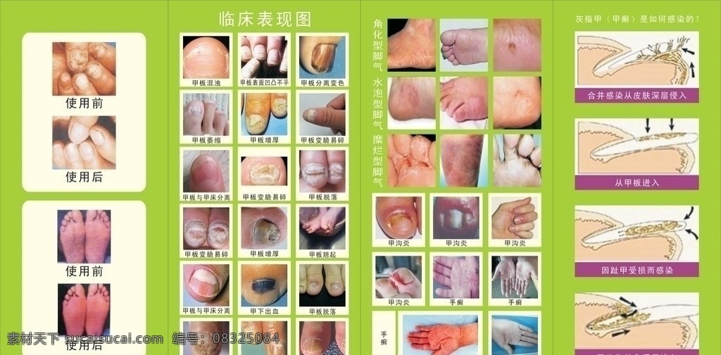 灰指甲 矢量