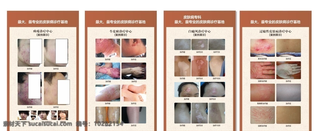 皮肤科喷绘 皮肤科挂图 痤疮对比 牛皮癣对比 白癜风对比 过敏性皮肤