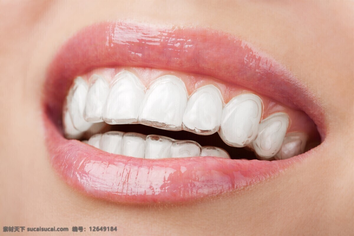 牙箍牙套图片 牙齿 牙箍 牙套 牙线 洁白牙齿 牙齿矫正 口腔护理 牙科 牙模型 文化艺术
