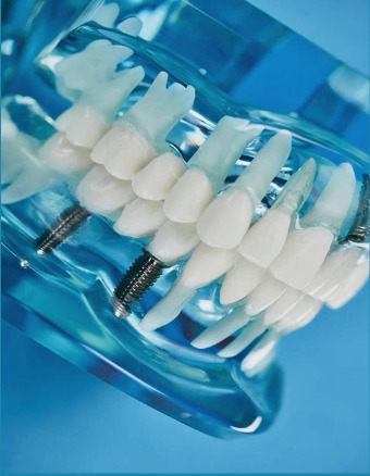 种植牙图片 种植 牙齿 白色 模型 蓝色 生活百科 医疗保健
